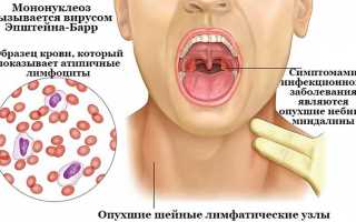 Симптомы вируса Эпштейна-барра у ребенка