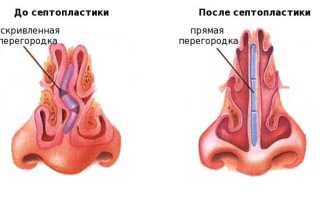 Септопластика: исправление искривления носовой перегородки